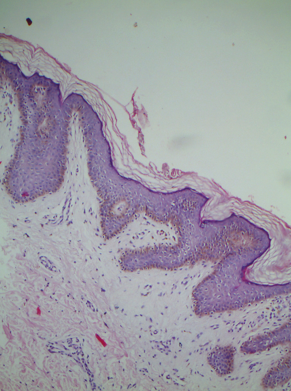 Histopathology of confluent reticulated papillomatosis showing basket-weave hyperkeratosis, focal acanthosis, increased melanin in basal layer hyperpigmentation, and papillomatosis (H and E, 10x)