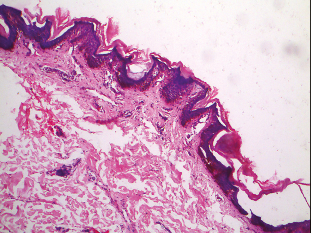 Histopathology of terra firma-forme dermatosis showing lamellar hyperkeratosis and papillomatosis with melanin deposition within the basal layer (H and E, 10x)