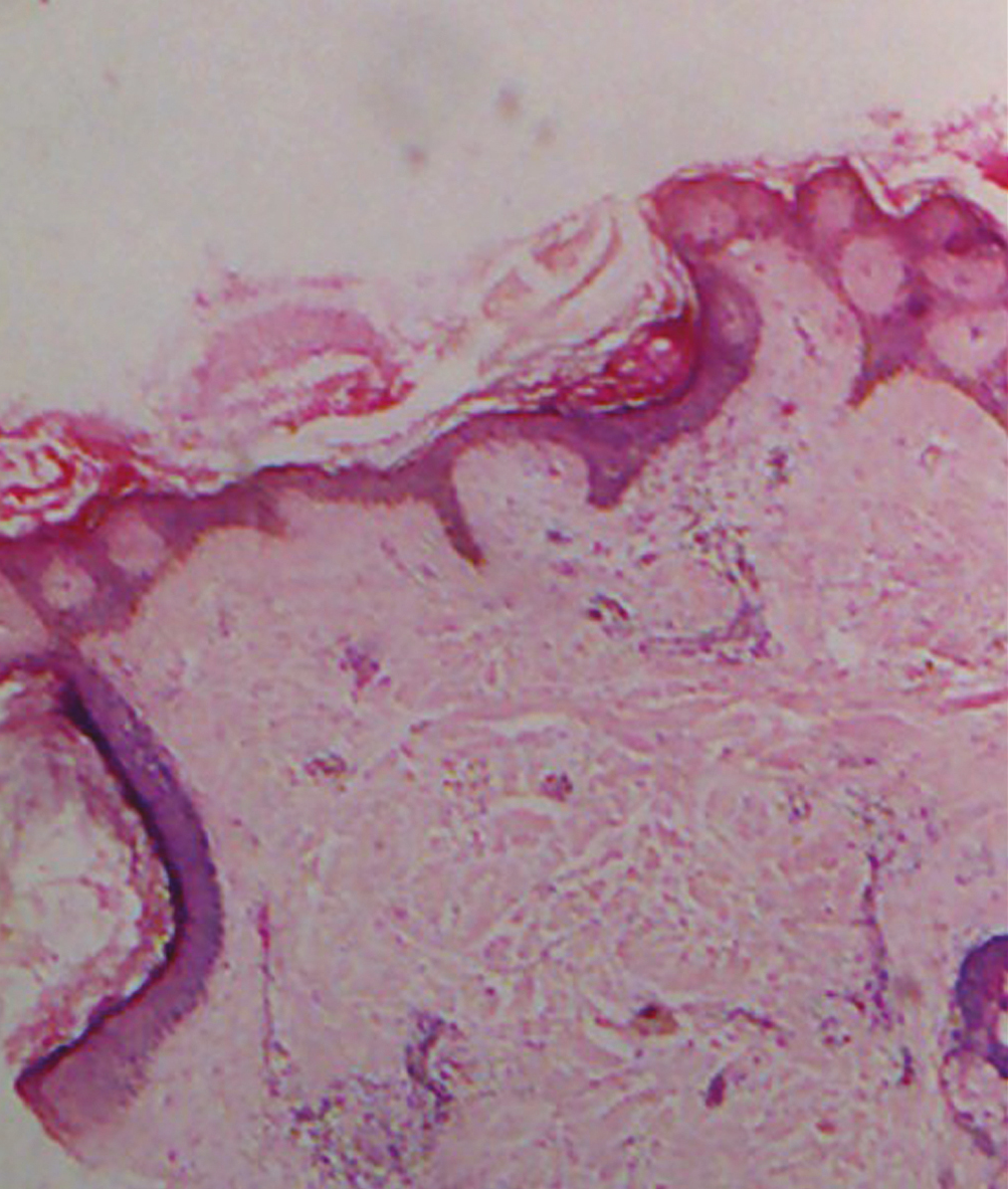 Histopathology of dermatitis neglecta showing compact ortho-hyperkeratosis, papillomatosis, and increased melanin in the epidermis (H and E, 10x)