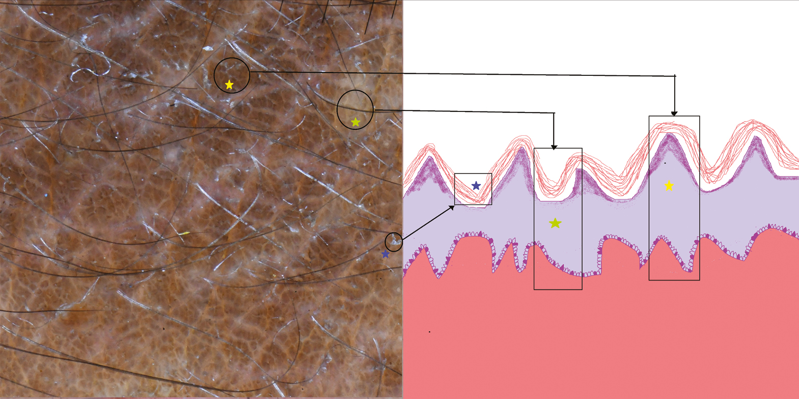 Schematic of confluent reticulated papillomatosis showing dermoscopic and histopathological correlation, ridge with papillomatosis (yellow stars), white areas with hyperkeratosis, and atrophic epidermis in the valley (green stars) and scales with hyperkeratosis (blue stars)