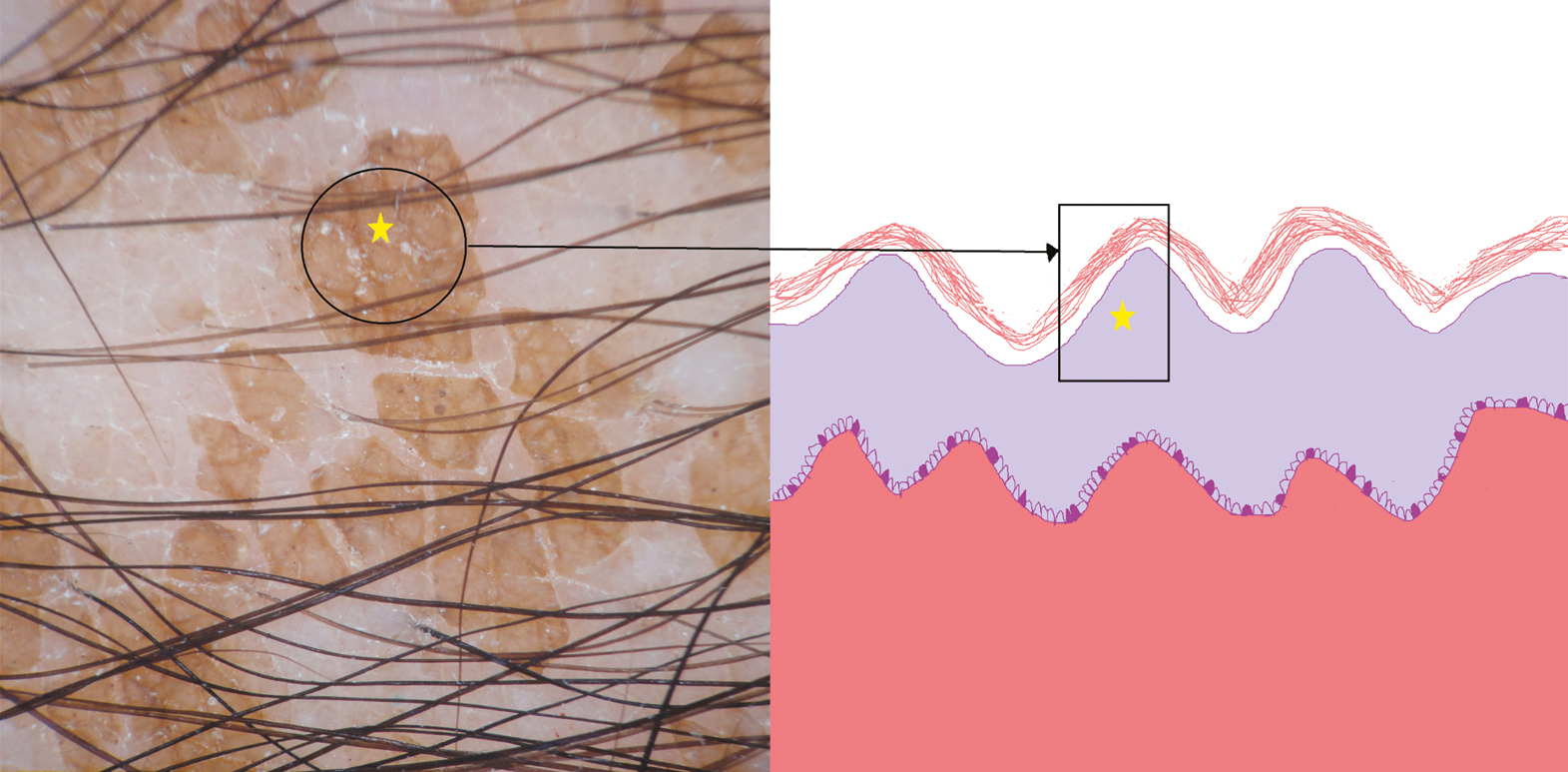 Schematic of terra firma-forme dermatosis showing dermoscopic and histopathological correlation; yellowish-brown globules with papillomatosis and acanthosis (yellow stars)