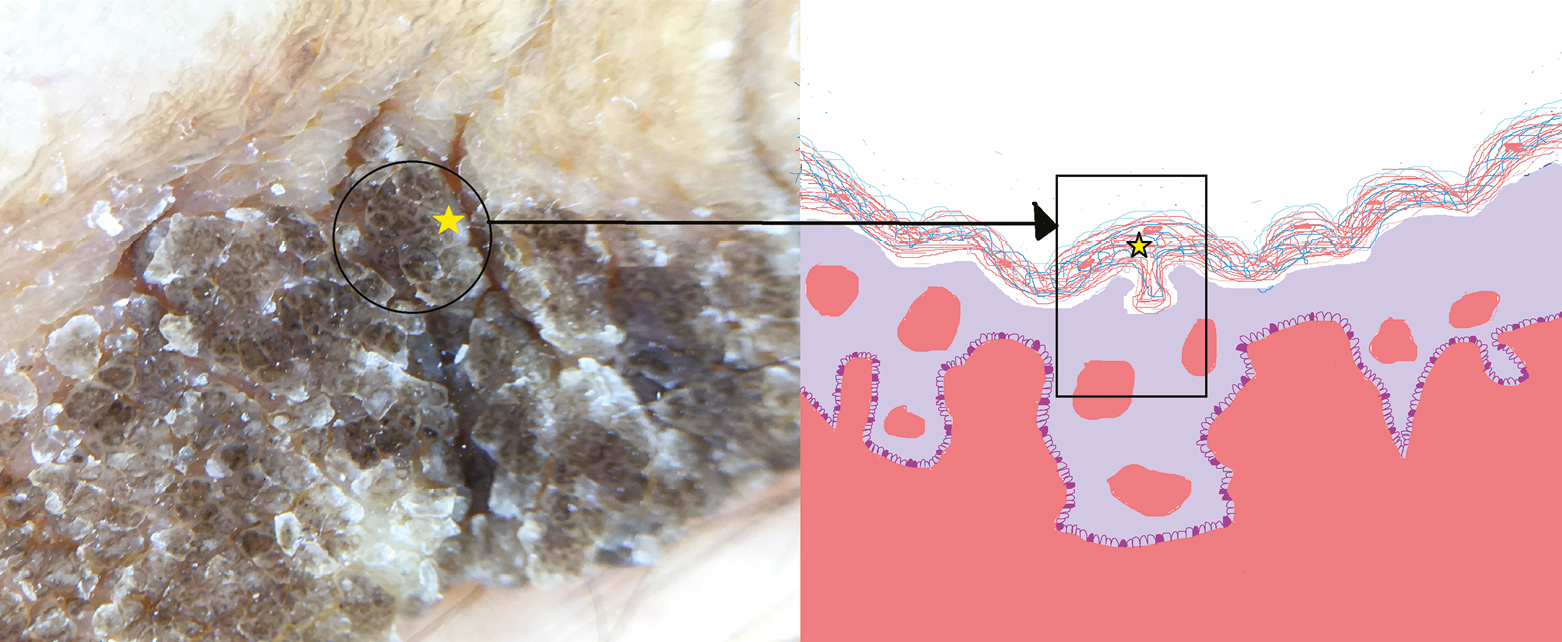 Schematic of dermatitis neglecta showing dermoscopic and histopathological correlation; blackish-brown globules with stacking of stratum corneum, debris, and dirt (yellow stars)