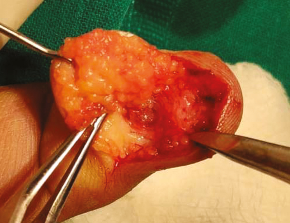 Intraoperative view of glomus before excision