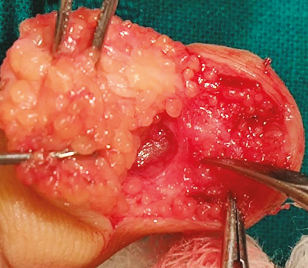 Intraoperative view showing bony erosion