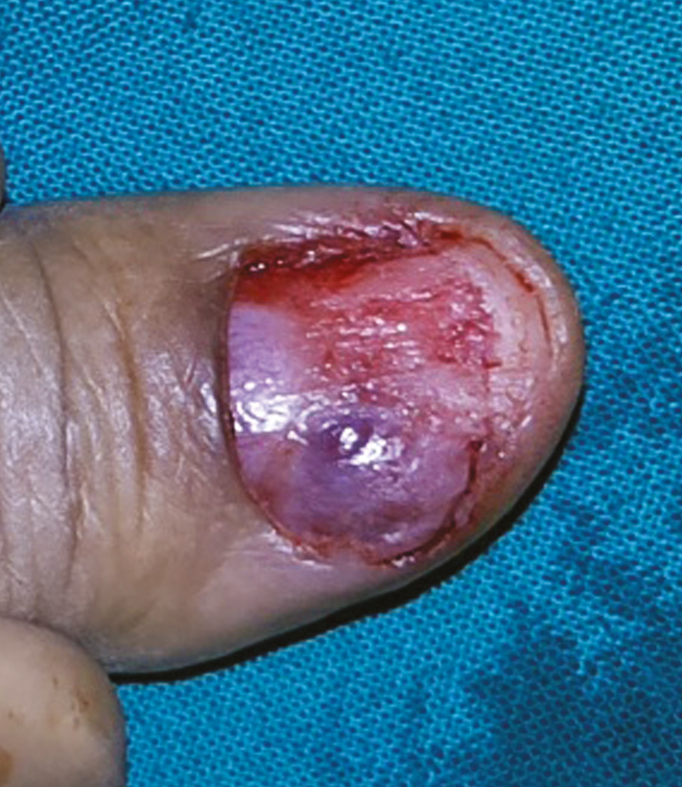 Glomus after total nail plate removal