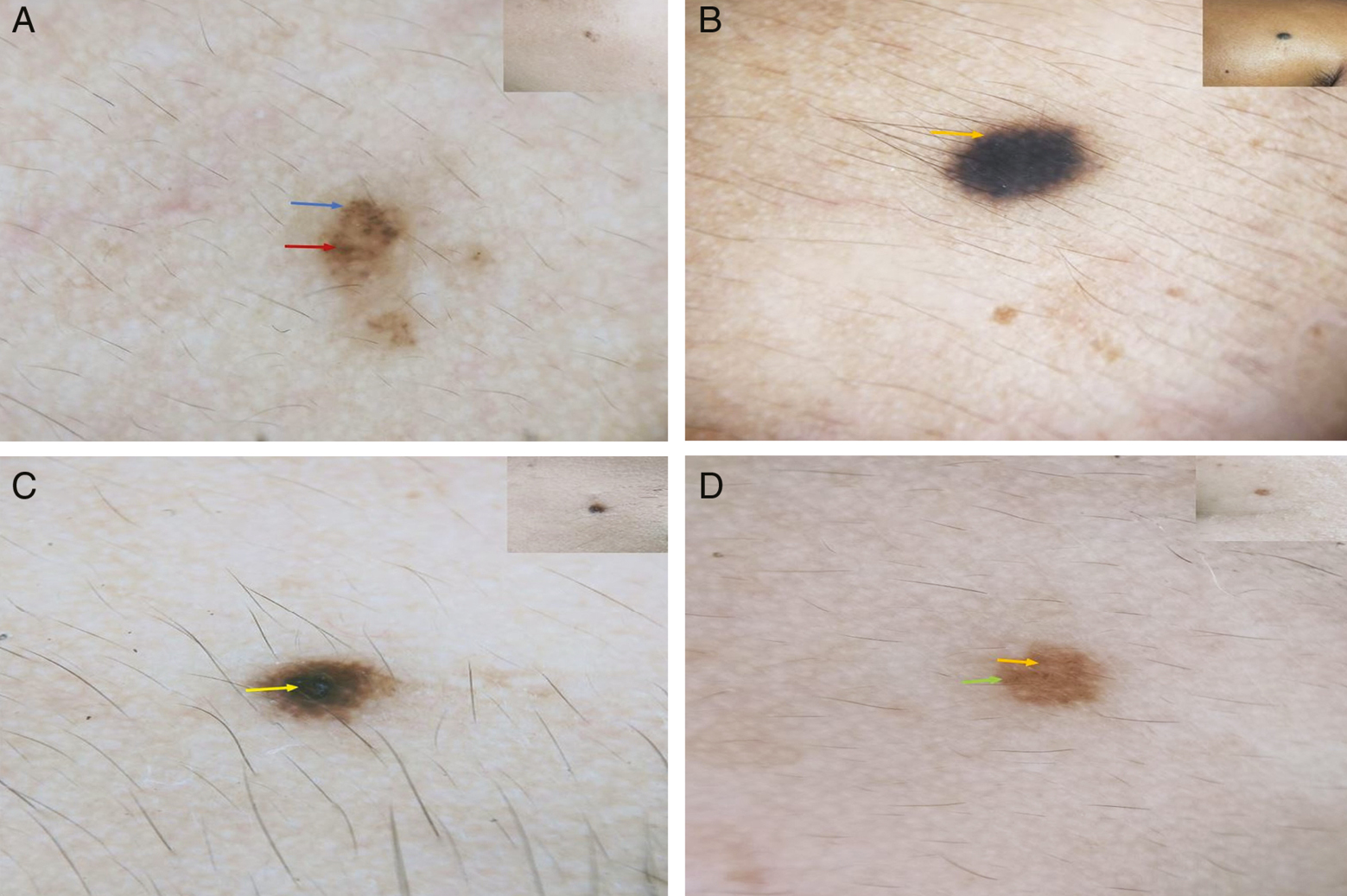 Dermoscopic polarized view images with corresponding clinical images in inset. (A) Dots (blue arrow) and globules (red arrow). (B) Pigment network (orange arrow). (C) Structureless areas (yellow arrow). (D) Dots (yellow arrow) and structureless areas (green arrows)