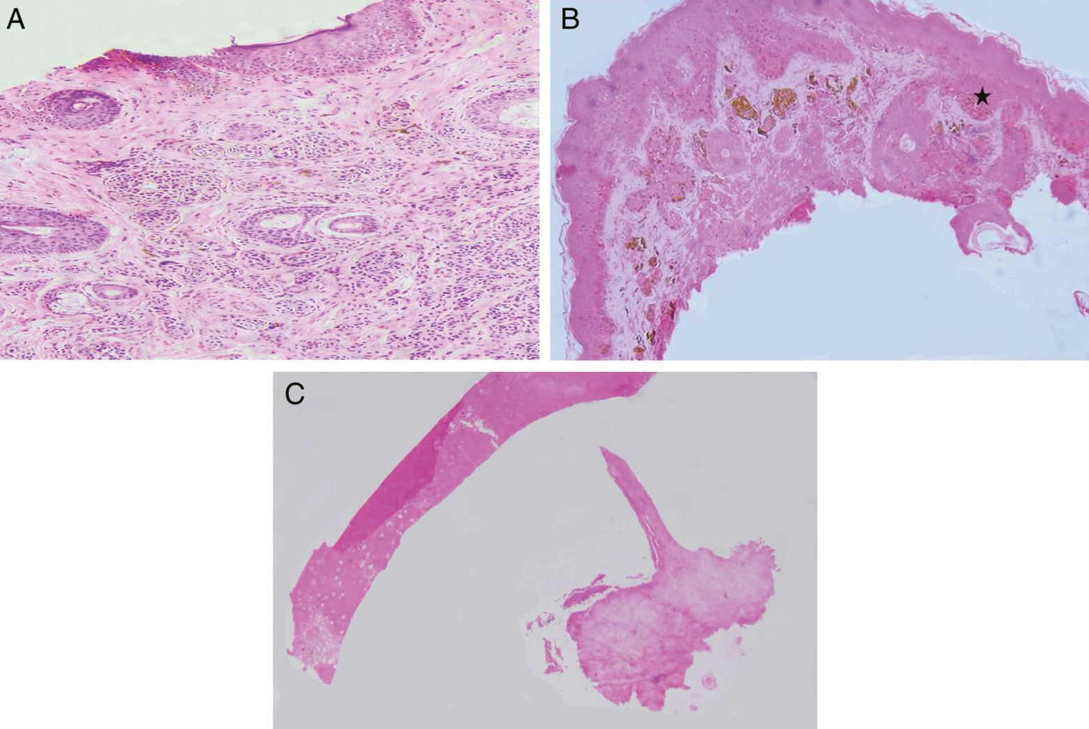 (A) Intradermal nevus showing nevus cell nest in the dermis with type A, B and C nevus cells with no junctional activity (100×, H&E). (B) Compound nevus showing nevus cell nest both in epidermis as well as in dermis with junctional activity (star) (100×, H&E). (C) Section shows unremarkable epidermis and dermis (100×, H&E)