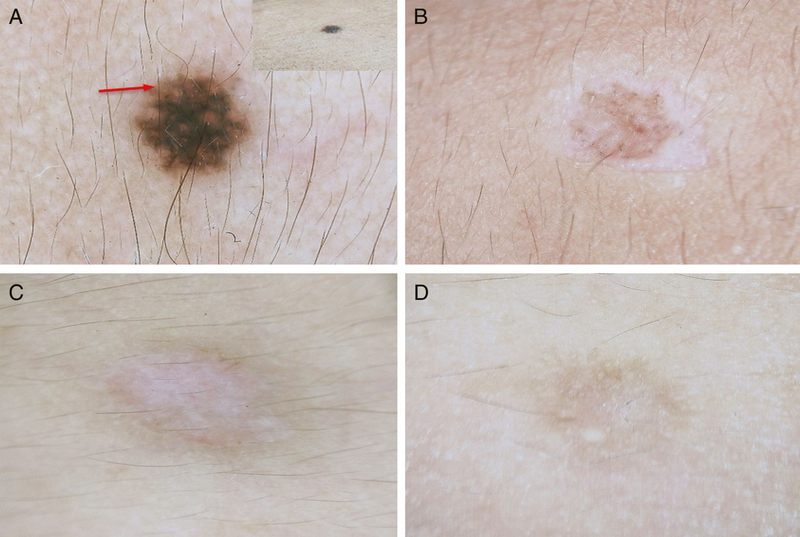 Dermoscopic polarized view images of a nonrecurrent nevi. (A) Dermoscopic image showing pigment network with clinical image of the nevus in inset. (B) Dermoscopic image following shave excision and radiofrequency. (C) Dermoscopic image after 6 weeks, no recurrence. (D) Dermoscopic image after 12 weeks, no recurrence