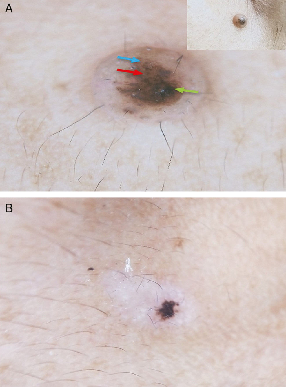 Dermoscopic polarized view images of a recurrent nevus. (A) Dermoscopic image showing dots (red arrow), globules (blue arrow), and structureless areas (green arrow) of an intradermal nevus with clinical image in inset. (B) Dermoscopic image of a recurrent nevus after 12 weeks.