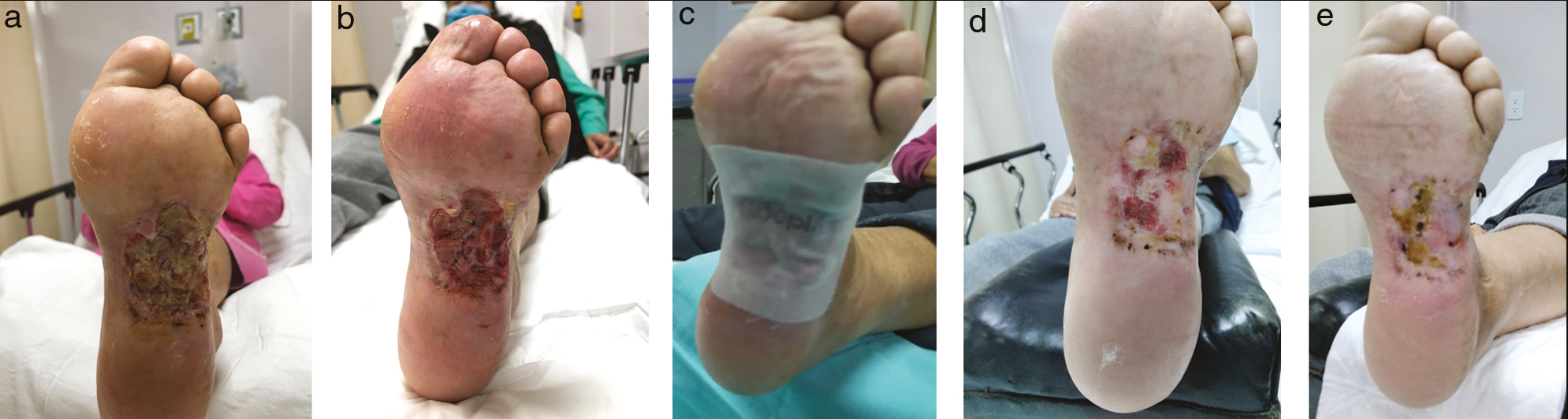 Diabetic ulcer in left plantar area with 4 months of evolution. (A) Chronic wound in the first clinical assessment. (B) At the end of the “TIME” protocol. (C) Pre-fabricated biological allograft applied. (D) Chronic wound at the end of the first application. (E) Chronic wound at the end of the second application