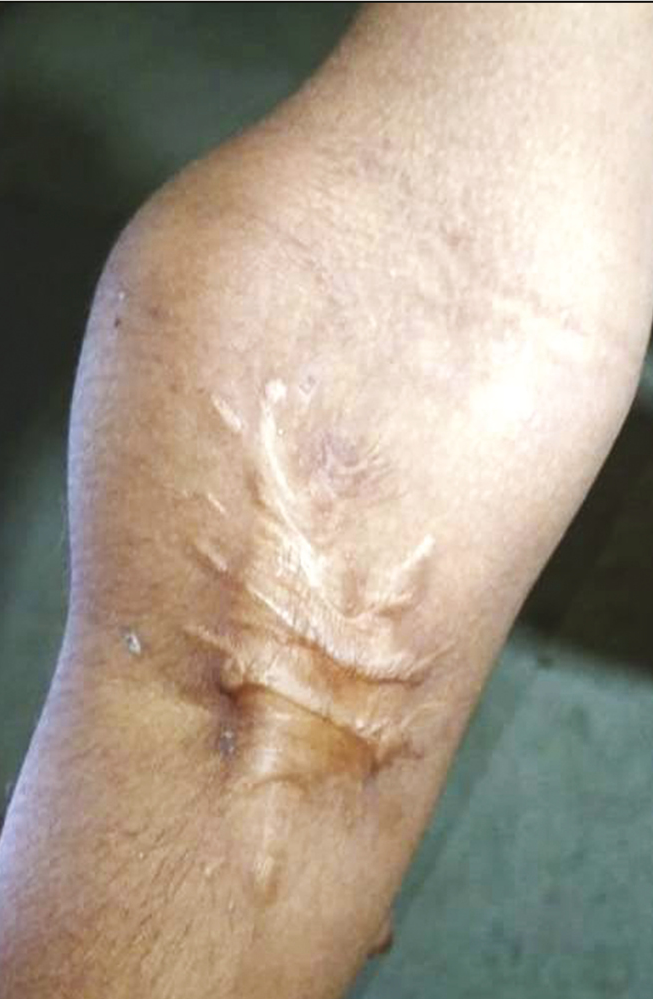 Surgical excision of a forearm lymphatic malformation in a child resulting in recurrence and poor cosmesis