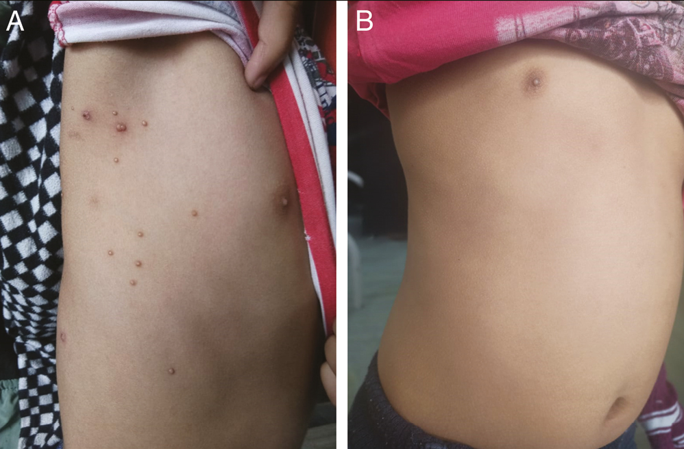 (A) A 9-year-old boy with MC showing before the procedure, and (B) after the procedure (20% GA) after 4 weeks