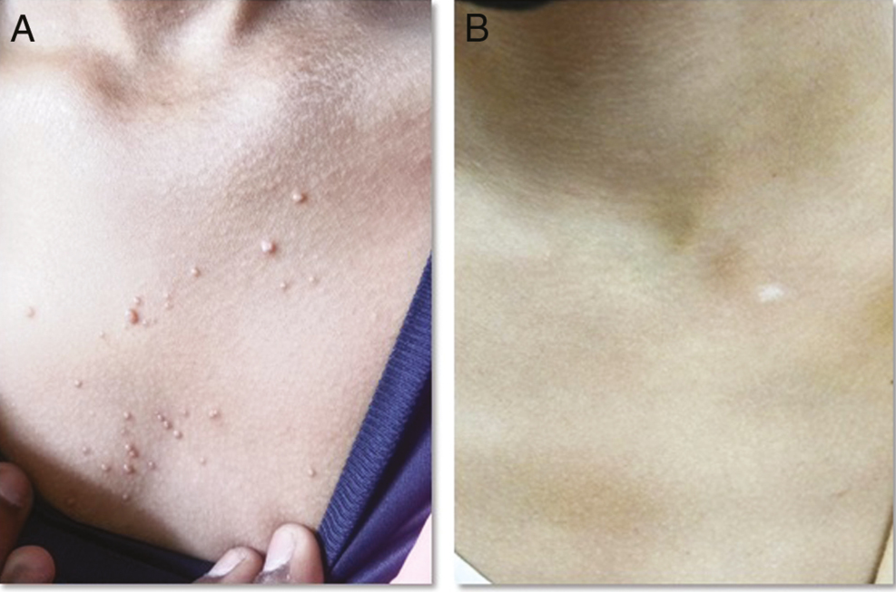 (A) A patient with MC showing before the procedure, and (B) after the procedure (30% SA) after 4 weeks