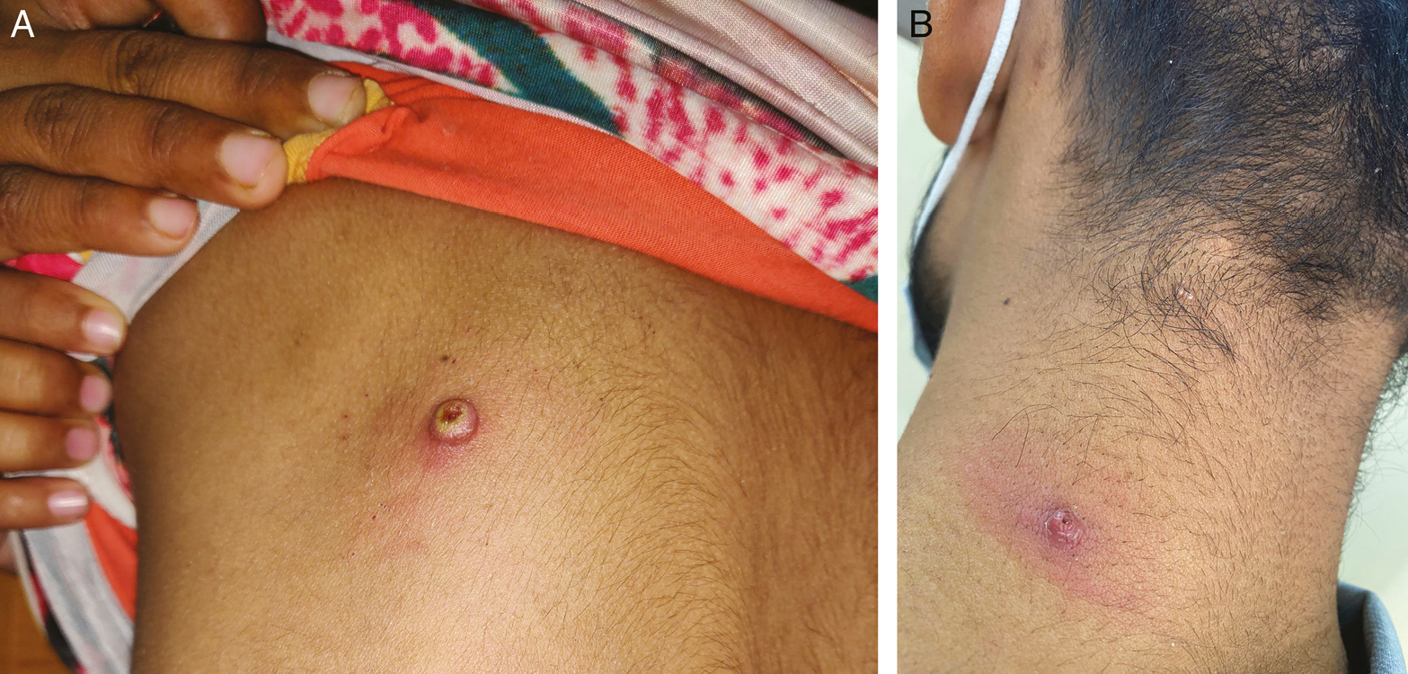 (A) Secondary bacterial infection in MC, which was treated with 20% GA, and (B) allergic reaction to 30% SA in the lesion of MC