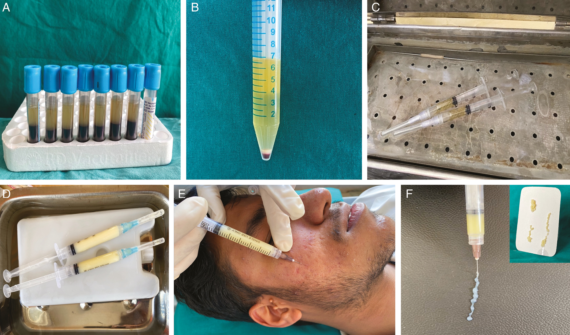 (A) After the first centrifugation, the plasma separates from the whole blood. (B) After the second centrifugation, we get upper 4–5 mL of PPP and a platelet-rich clot settled. (C) The PPP is heated at 80°–100° for 5 min. (D) Biofiller formed after the heated plasma is placed in a cold bath of 0°–6° for 5 min. (E) Typical semisolid consistency of the biofiller. (F) PPP gel is injected below each scar with to-and-fro motion to deposit the depot and massaged gently