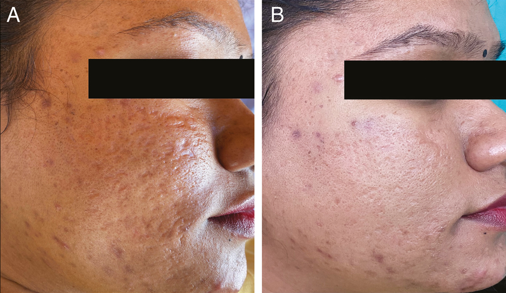 (A) Pretreatment photograph of the patient showing acne scars of GBS grade 4, GBS scale 28, PGA-grade 4, and VAS-0. (B) At the seventh visit, GBS grade 2, scale reduced to 8, PGA-grade 2, and VAS-3 (extremely satisfied)