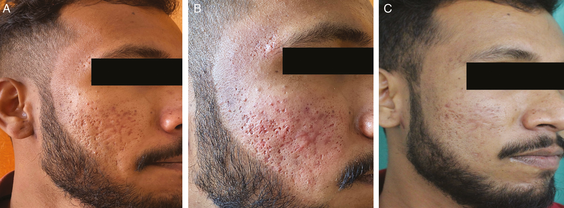 (A) Pretreatment photograph of the patient showing acne scars of GBS grade 3, GBS scale 24, PGA-grade 3, and VAS-0. (B) Immediate volumetric effect and transient erythema. (C) At the seventh visit, GBS grade 2, scale reduced to 10, PGA-grade 2, and VAS-3 (extremely satisfied)