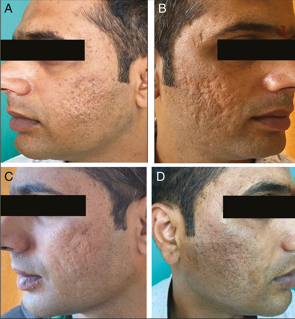 (A) and (B) Both cheeks pretreatment photograph of the patient showing acne scars of GBS grade 4, GBS scale 26, PGA-grade 4, and VAS-0. (C) Mild postinflammatory hyperpigmentation on the right cheek. (D) At the sixth visit, GBS grade 2, scale reduced to 7, PGA-grade 2, and VAS-3 (extremely satisfied)