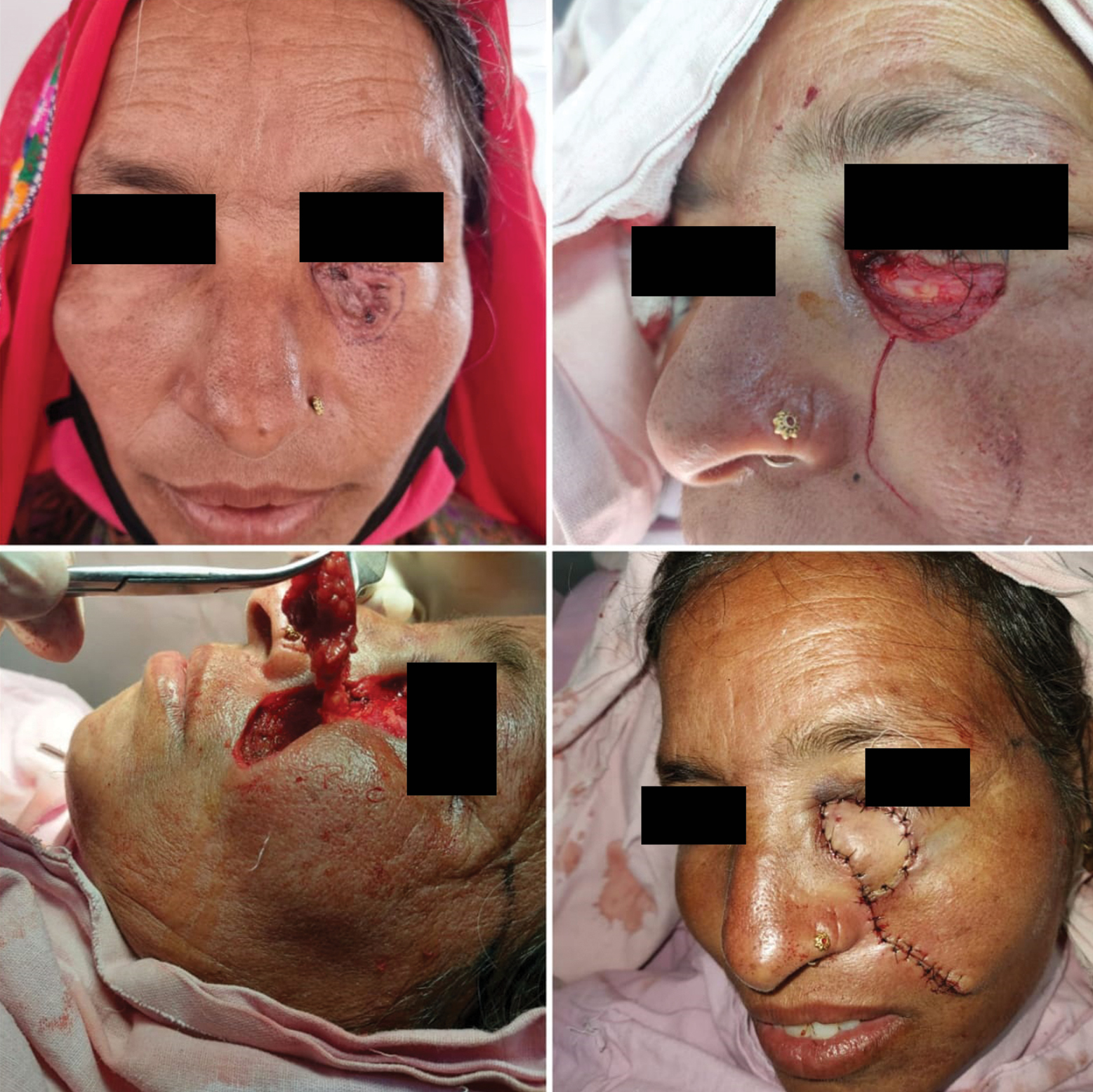 Facial artery perforator flap from nasolabial region