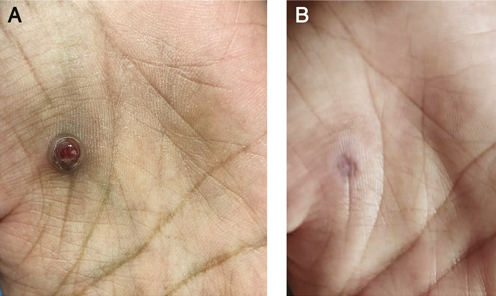 (A) Before treatment. (B) After 1 session