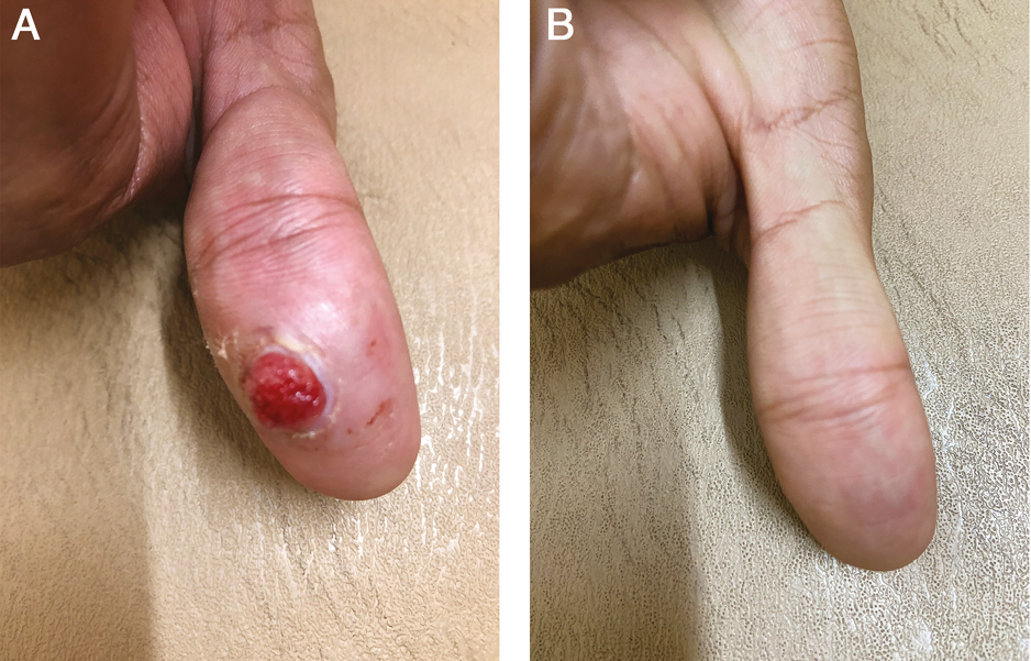 (A) Before treatment. (B) After 1 session