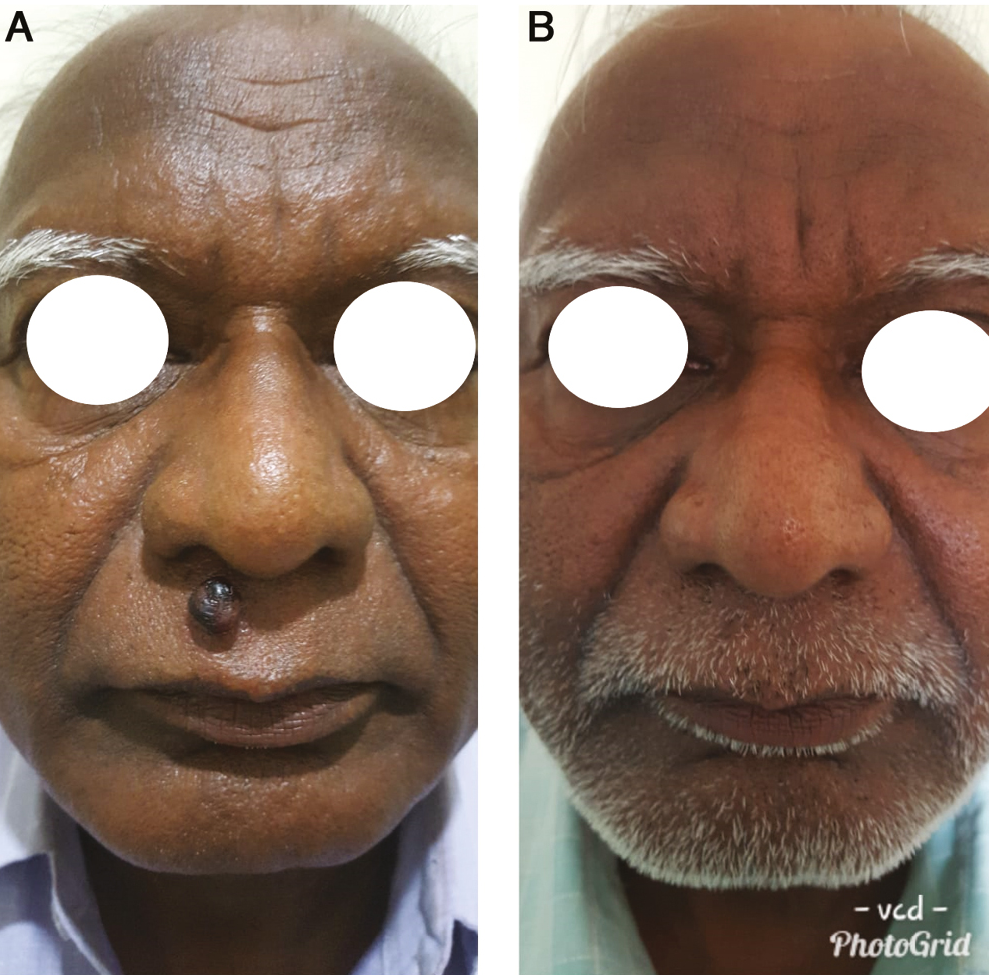 (A) Before treatment. (B) After 2 sessions