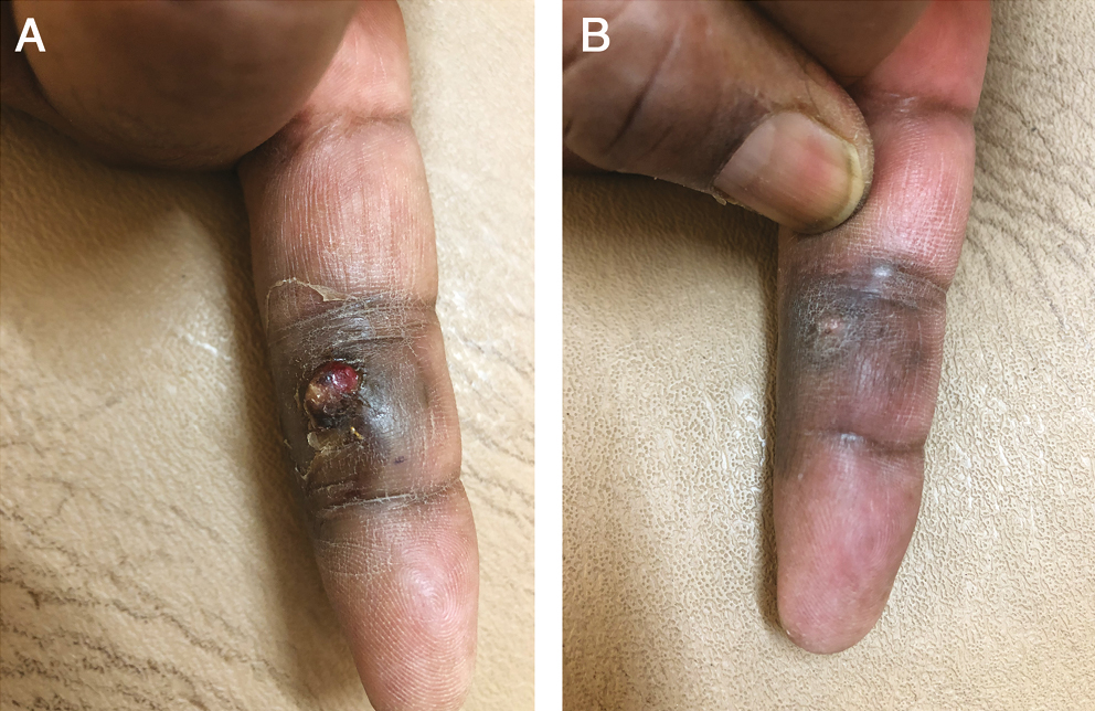 (A) Before treatment. (B) After 2 sessions