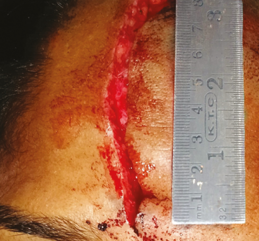 Laceration length measurement using measuring scale for group A