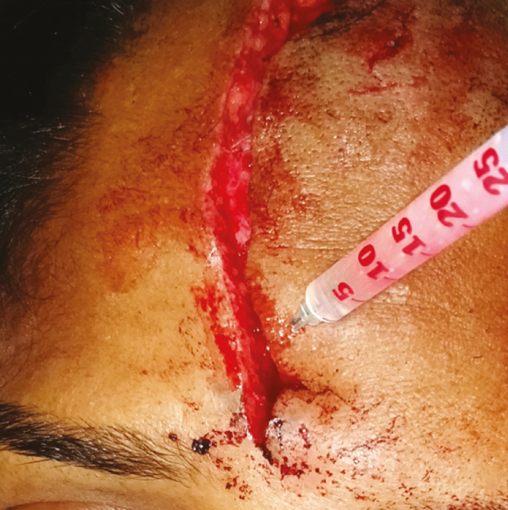 Injecting botulinum toxin adjacent to the laceration