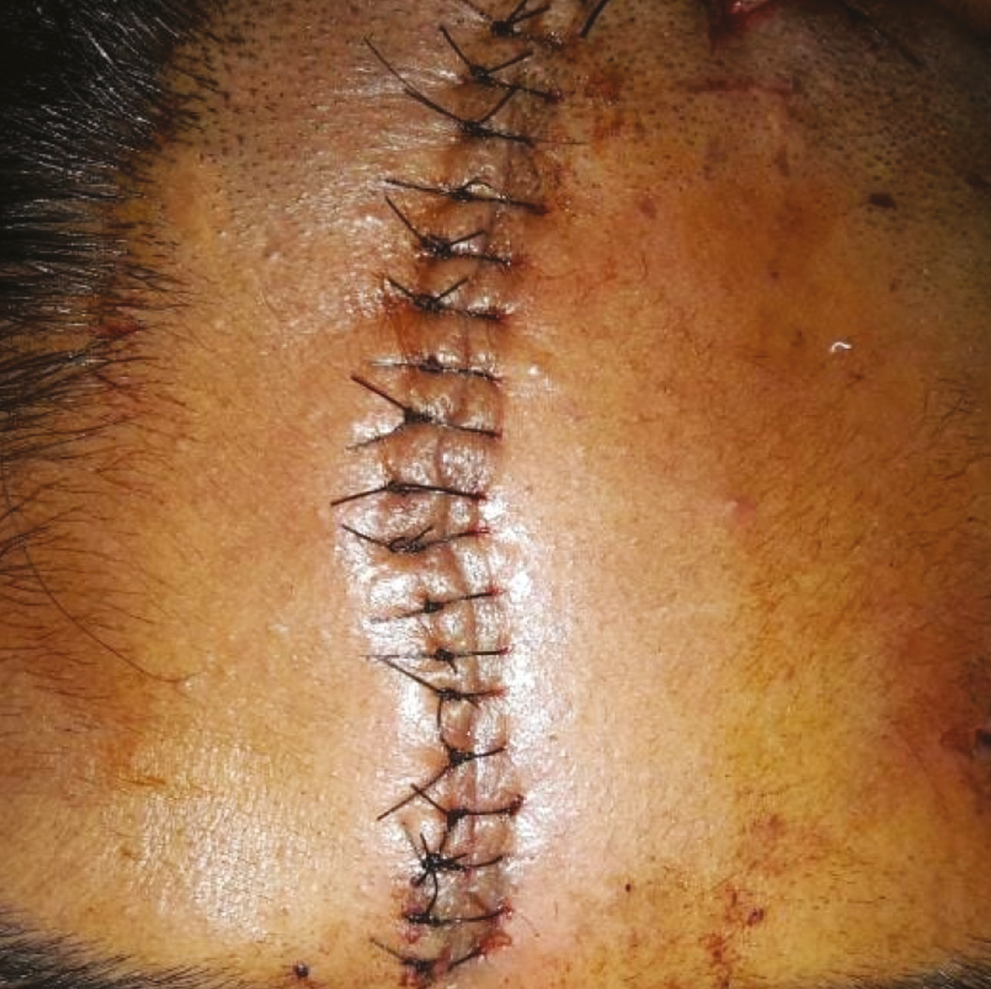 Layered closure of laceration