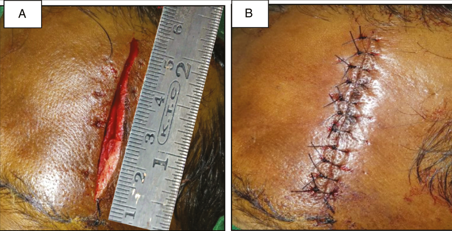 (A) Laceration length measurement using measuring scale for group B. (B) Layered closure of laceration