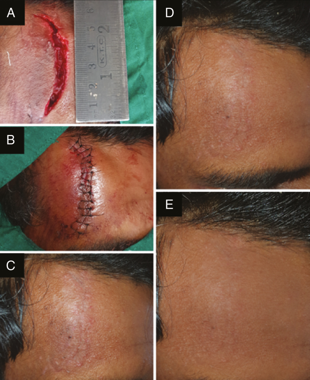 Photograph showing (A) laceration over the right frontal bone treated with BTX-A, (B) sutured laceration, (C) scar at 1 week follow-up after suture removal, (D) scar at 3 months follow-up, and (E) scar at 6 month follow-up