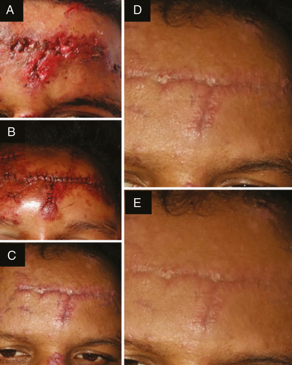 Photograph showing (A) laceration over the left frontal bone treated without BTX-A, (B) sutured laceration, (C) scar at 1 week follow-up after suture removal, (D) scar at 3 months follow-up, and (E) scar at 6 month follow-up