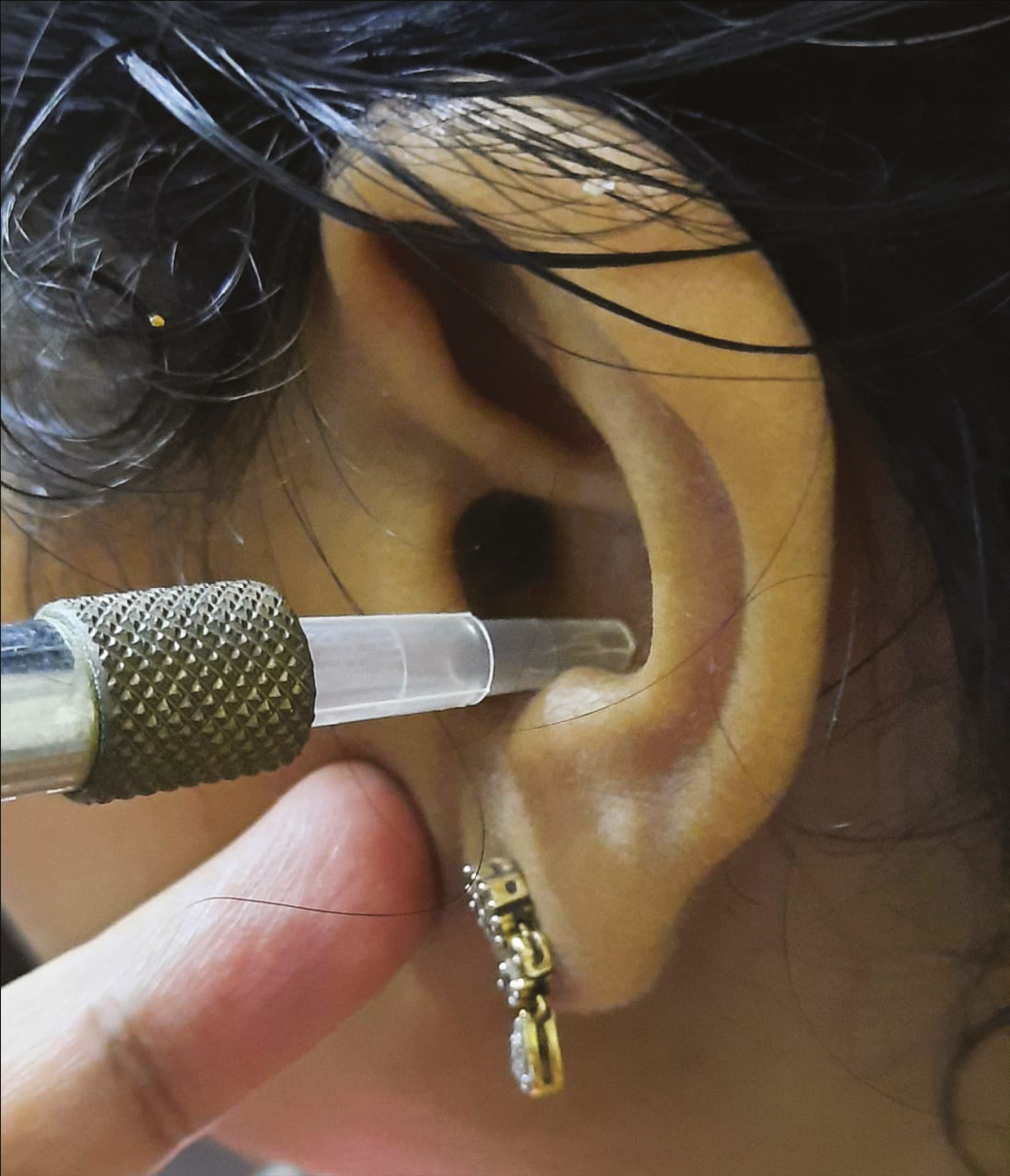 Disposable micropipette tip attached to cryocan nozzle for use inside the concha of ear