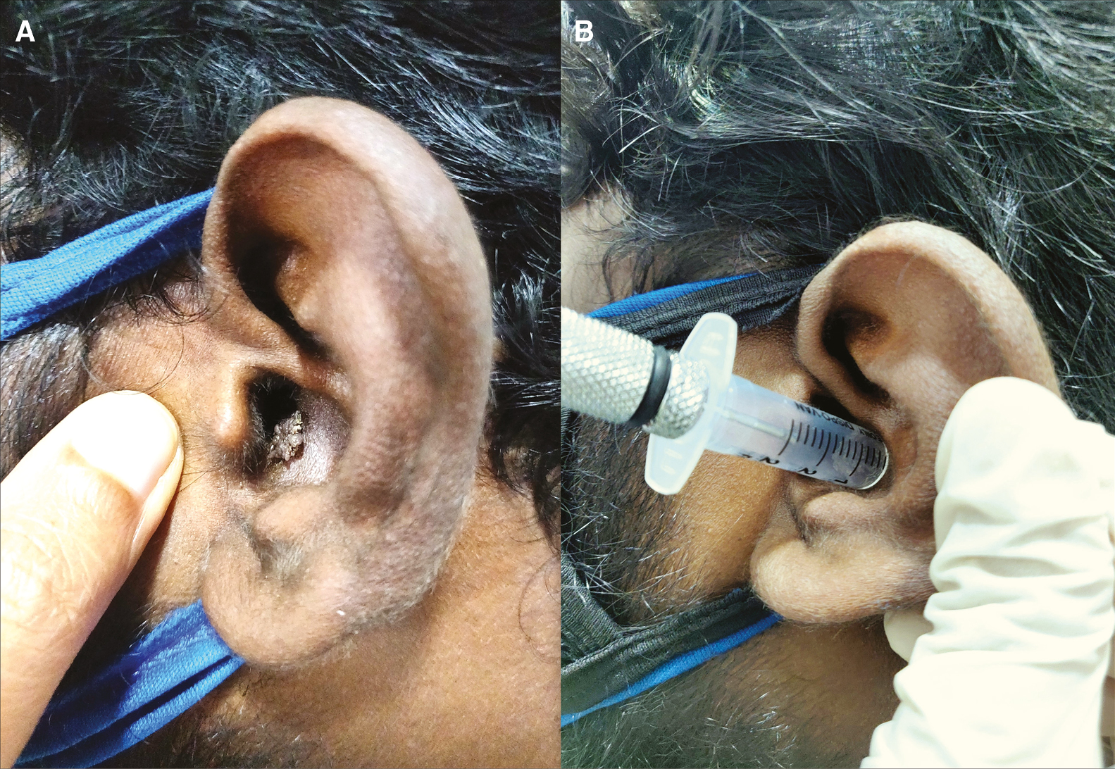 (A) Viral wart in the ear canal. (B) Targeted and stabilized cryotherapy using a modified syringe barrel attached over cryocan nozzle