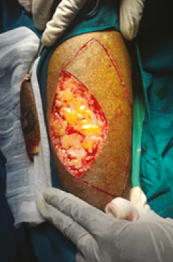 Blunt excision of the lesion