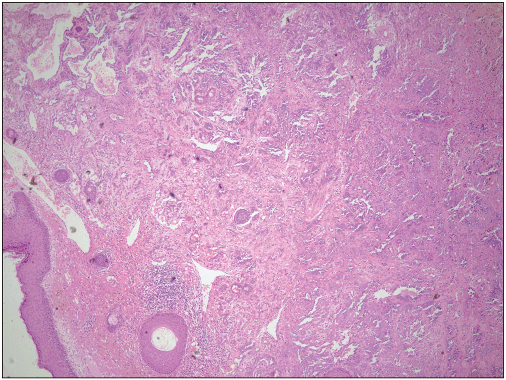 Biopsy showing an infiltrative lesion in the mid and lower dermis, resembling rete testis at scanner view (H&E, ×4)