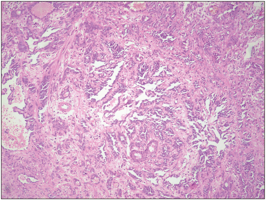 Low power view shows a vascular lesion composed of numerous, variably sized, arborizing vascular channels (H&E, ×10)