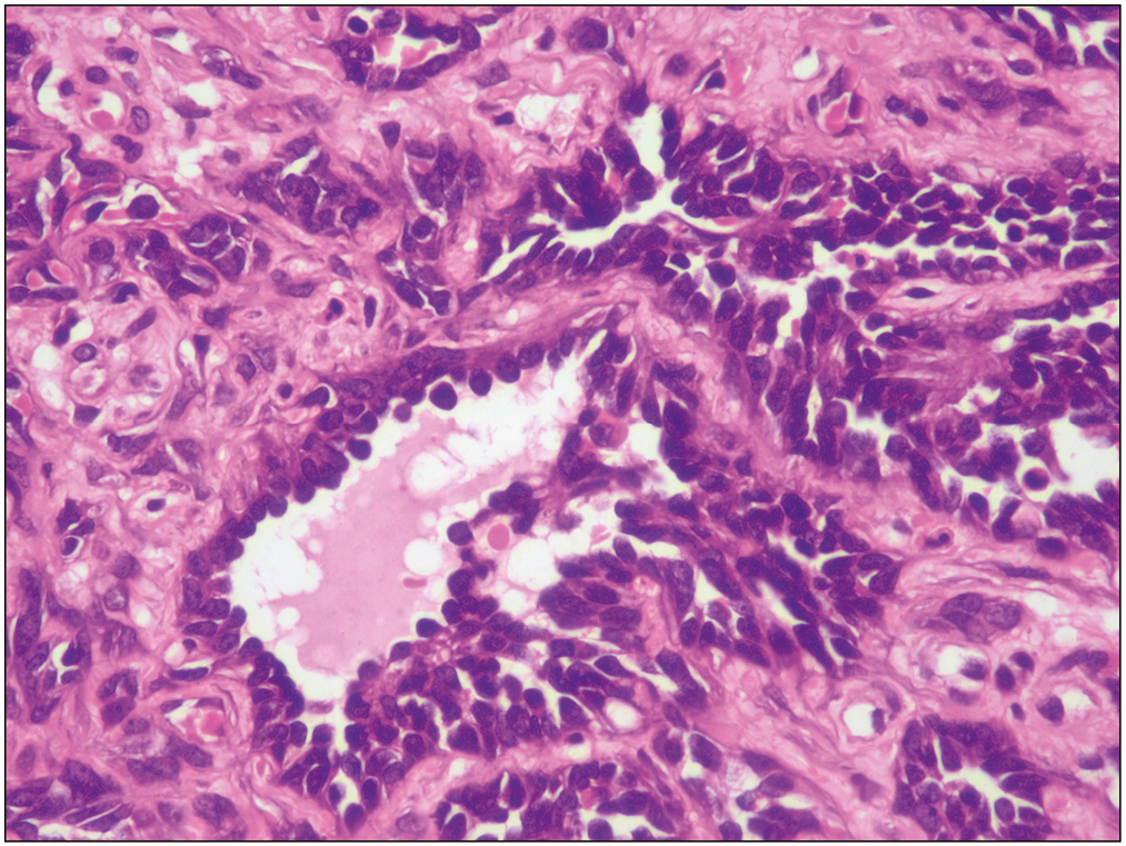 High power view shows the vascular channels lined with endothelial cells exhibiting hobnailing and absent to minimal cytological atypia. No mitoses were noted (H&E, ×40)