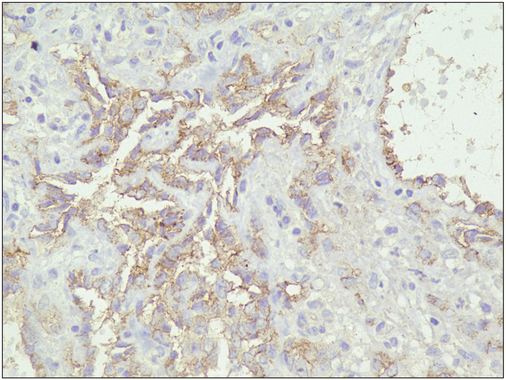 The lesional cells lining the channels show immunoreactivity for CD31 (IHC, ×40)