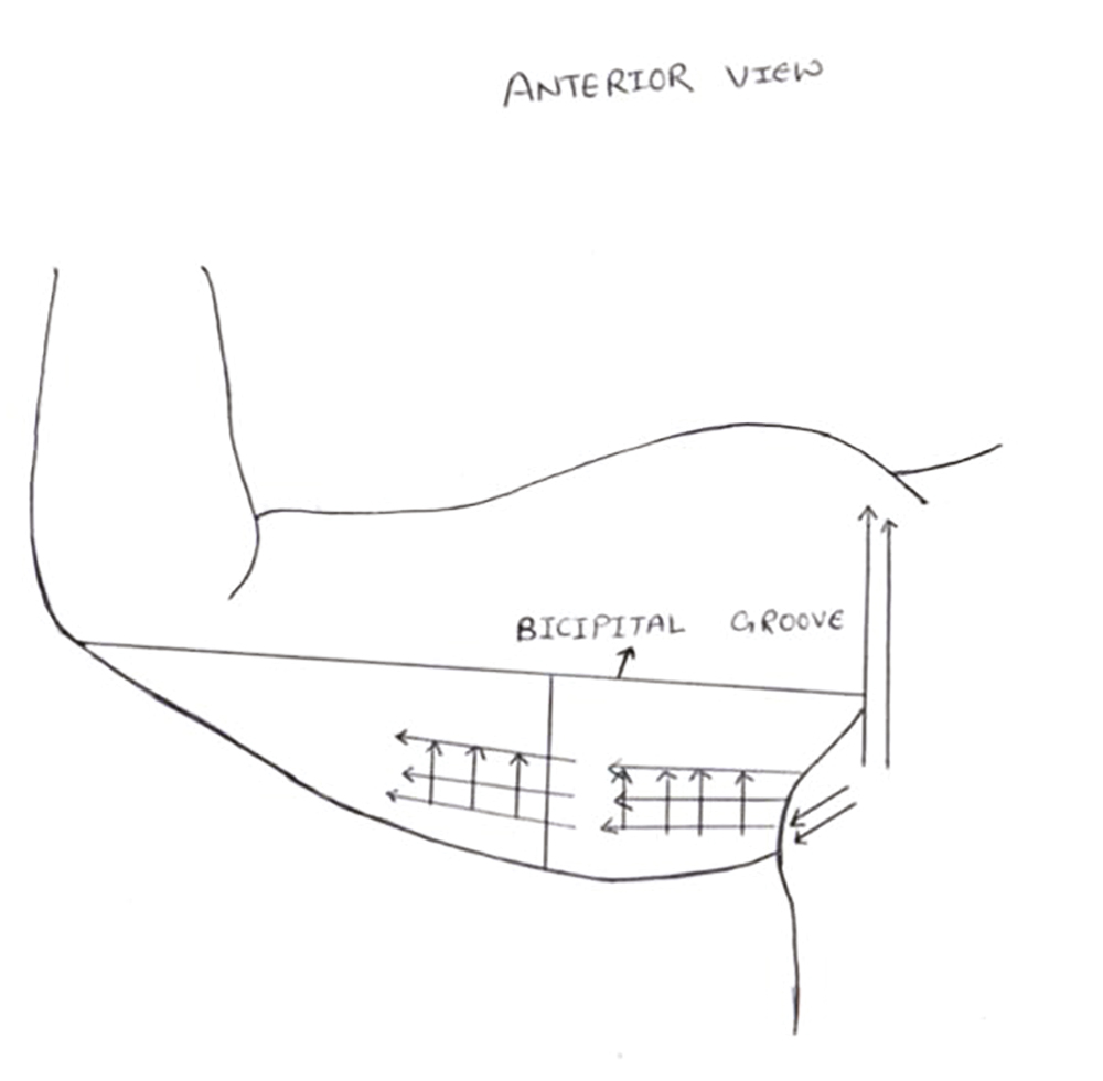 Anterior view markings for PDO thread placement and the vectors in which placement was done