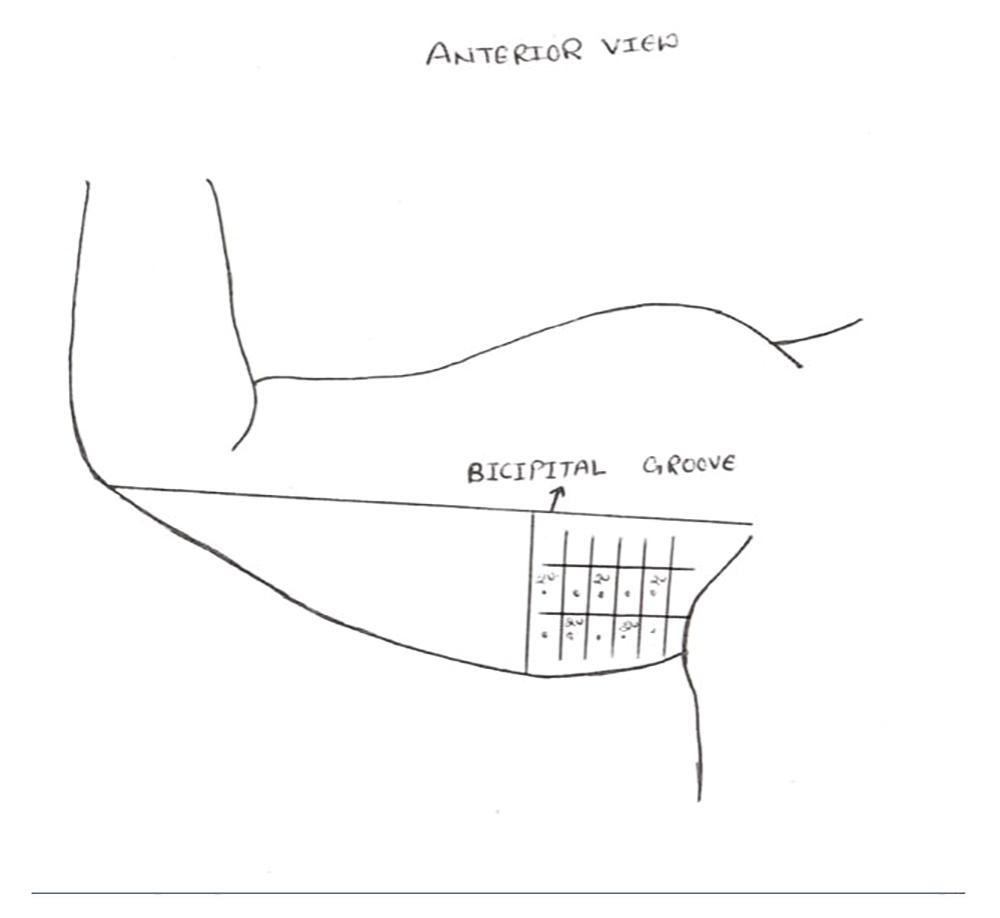 Markings on anterior aspect arm for injection, and medial half of arm was injected as shown