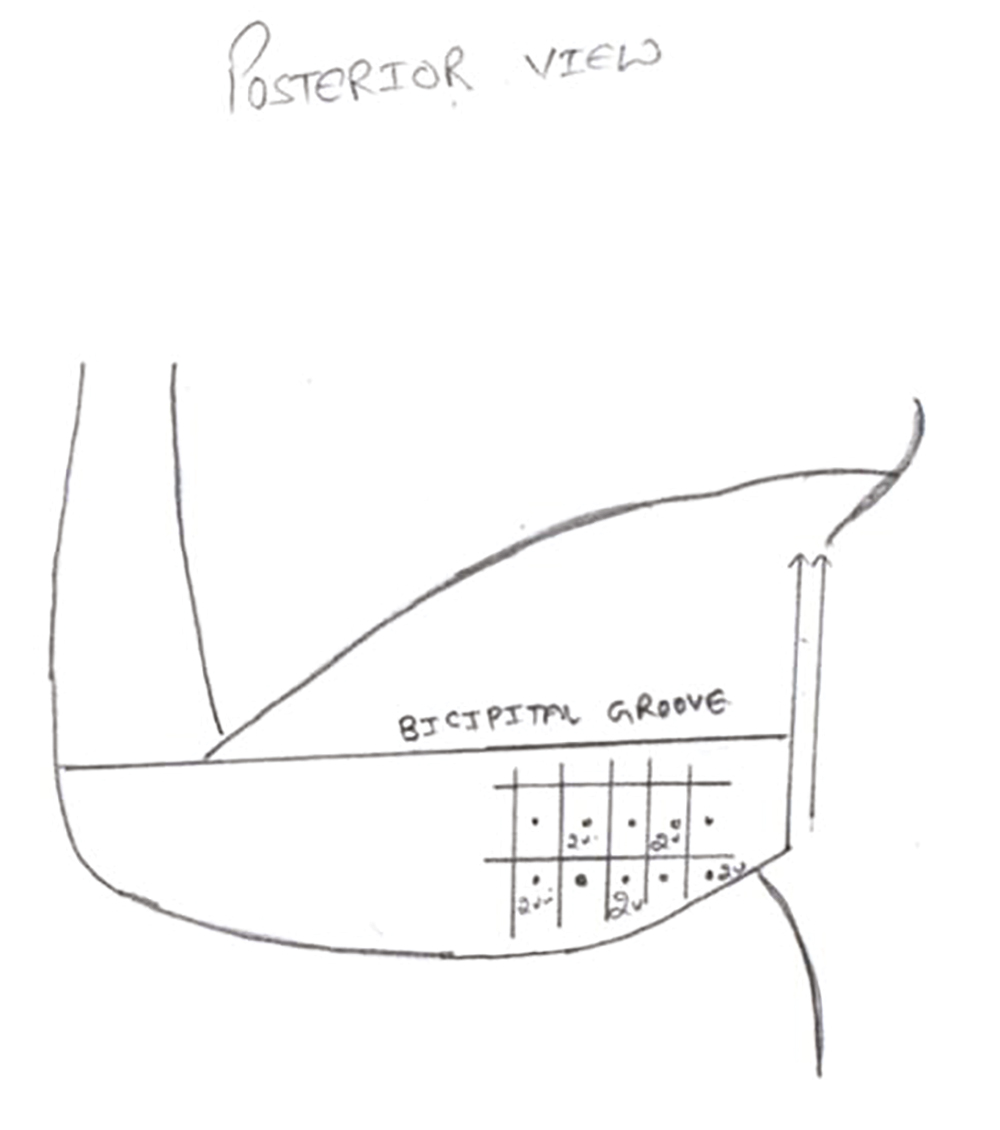 Markings on posterior aspect of arm for injection