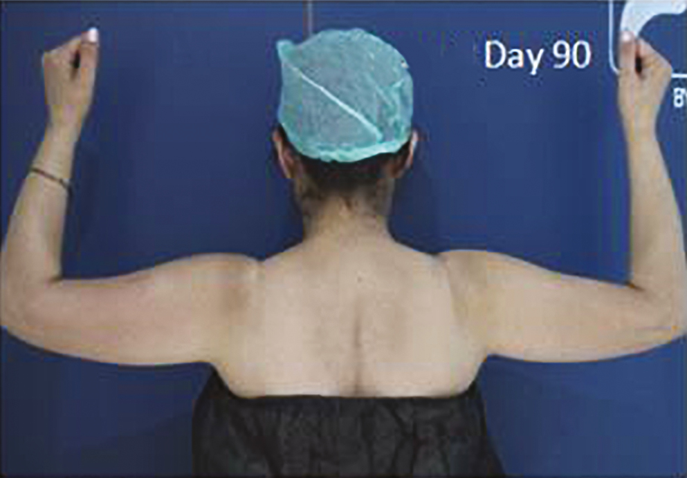 Clinical photographs of patient on day 90. Further improvements seen at day 90 after the procedure