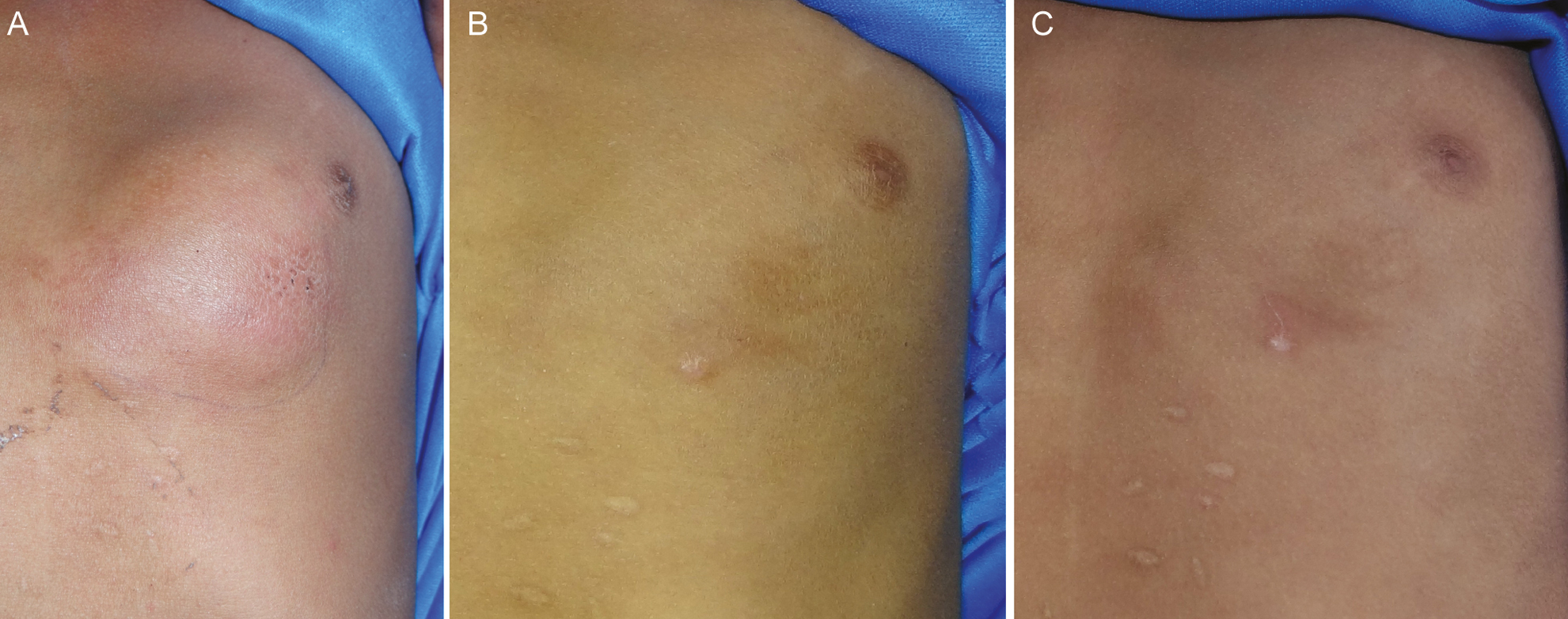 Clinical image of subcutaneous phycomycosis at first visit showing a subcutaneous nodule present over the left anterior chest region (A), marked improvement on 21st day (B), and complete resolution of lesion after 5 weeks of treatment (C)