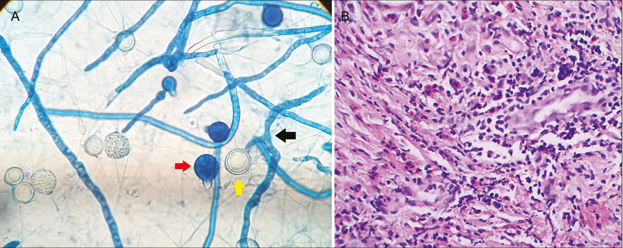 Microscopy of lactophenol cotton blue wet mount from the culture shows short broad hyaline pauci-septate hyphae with wide angle branching (black arrow). Spherical primary conidia with papilla (red arrow) with single nucleus and many thick-walled zygospores (yellow arrow) seen (A). Histopathology of phycomycosis showed diffuse granulomatous infiltrate consisting of lymphocytes, histiocytes, plasma cells, eosinophils, and a few foreign body giant cells. Among the infiltrate, thin-walled hyphae were seen as ring-shaped, twisted, or collapsed structures (H&E, 100× magnification) (B)