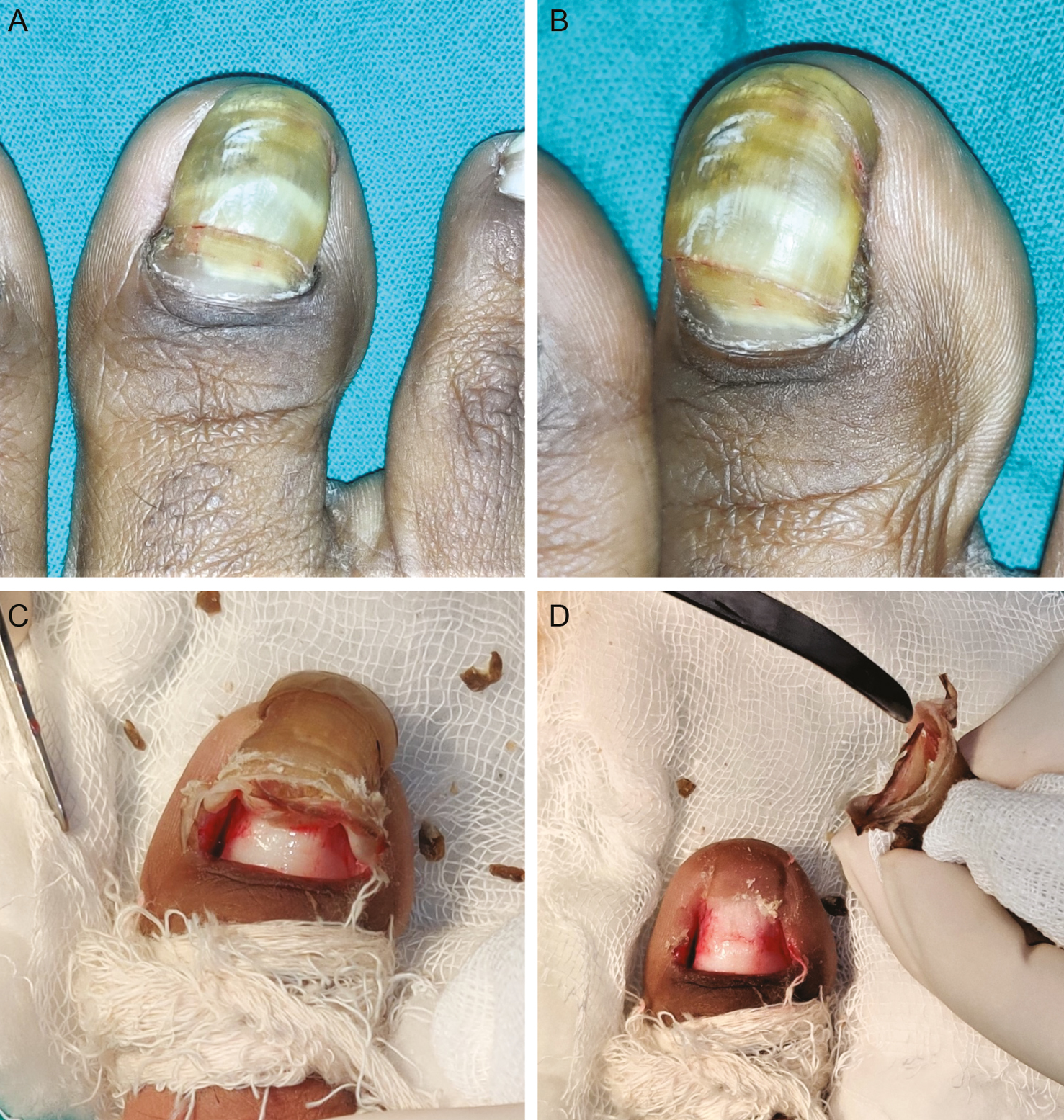 A. Dorsal view of the right great toenail showing xanthonychia, thickening, and increased longitudinal curvature. Note the prominent hyperpigmentation of the proximal nail fold. B. Lateral view demonstrating the heaped-up nail plate. C. Proximal total nail avulsion of the impacted nail plate shows multiple layers. D. The avulsed nail plate more clearly seen to show multiple layers. The underlying nail bed is healthy but distally epithelialized