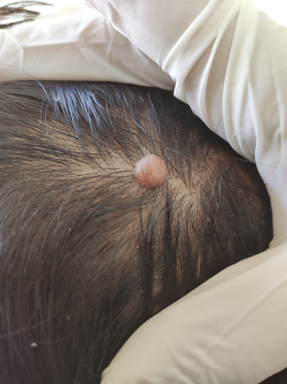 A solitary pinkish white fibrotic nodule on the scalp