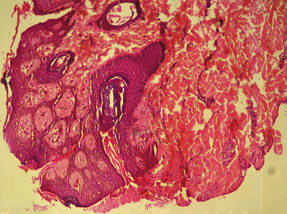 Thin anastomosing cords of epithelial cells arising from the epidermis and extending to the dermis (H&E ×40)