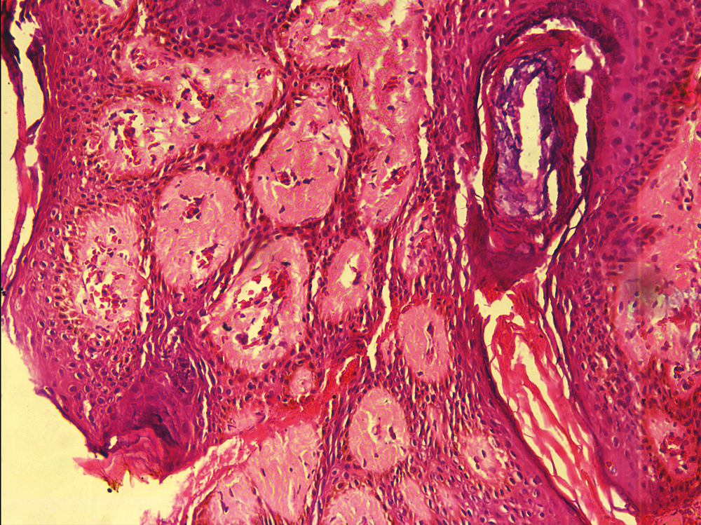 Higher magnification of anastomosing cords composed of epithelial cells (H&E ×100)